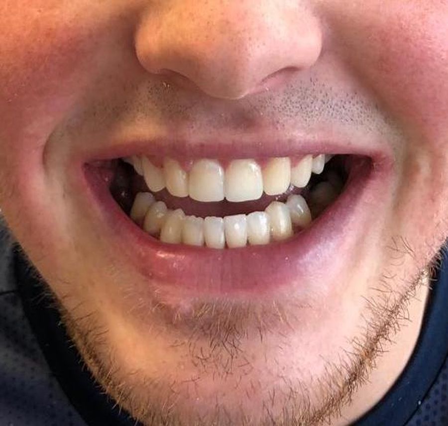 6 month braces & dental bonding - after - 3dental